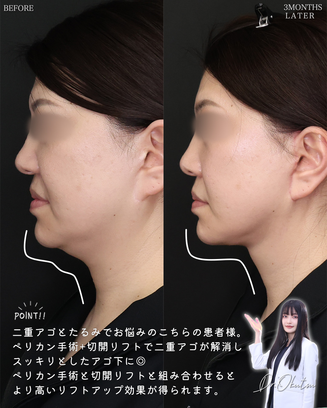 フェイスリフト（切開）/TAC式 ツヤ肌コラーゲンリフト®/顔の脂肪吸引の症例写真 施術前後 