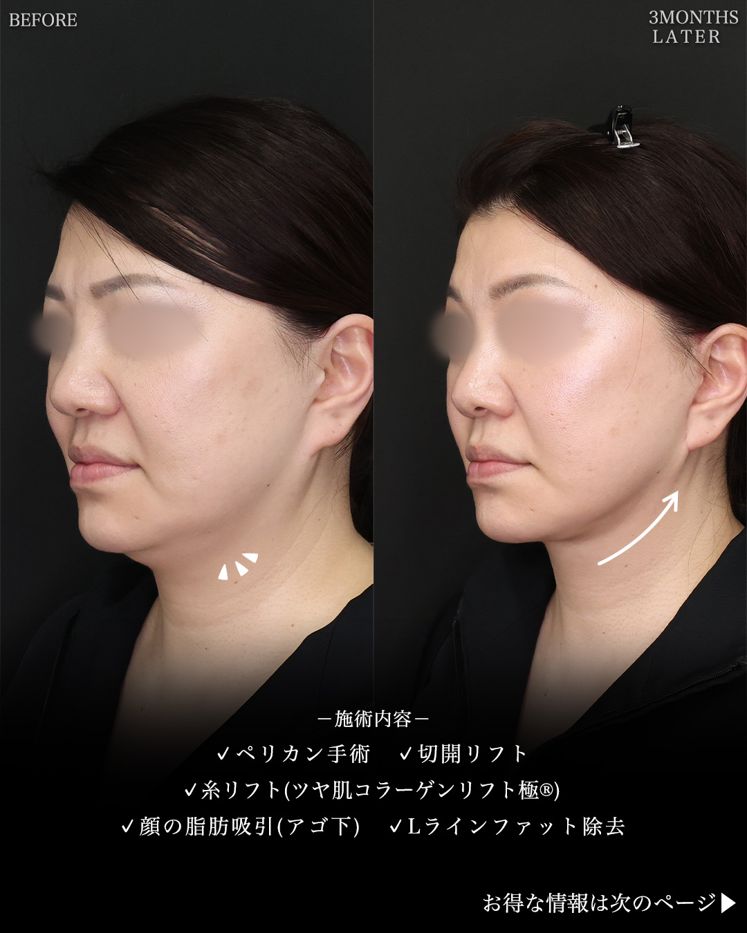 フェイスリフト（切開）/TAC式 ツヤ肌コラーゲンリフト®/顔の脂肪吸引の症例写真 施術前後 