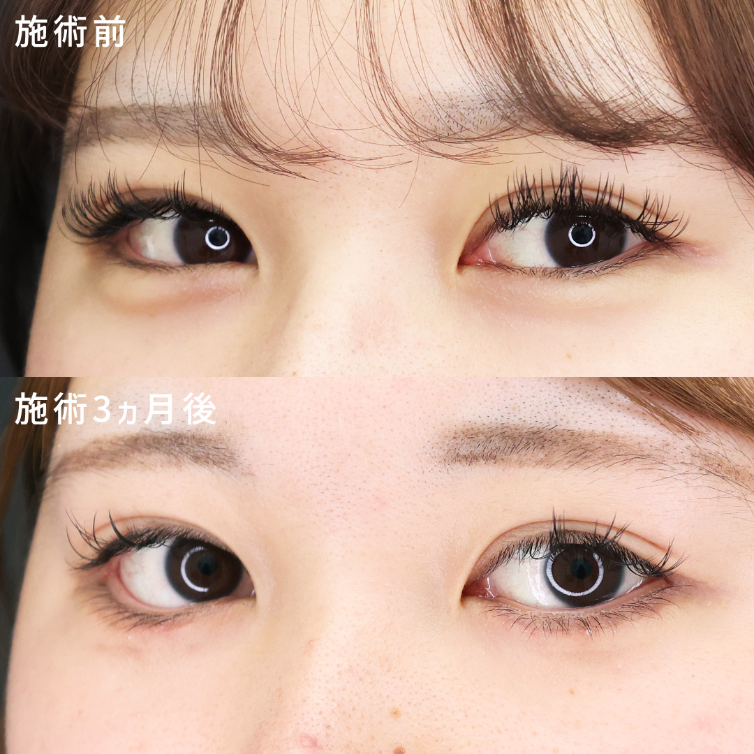 ナチュラルに盛れる目│目尻切開×タレ目形成