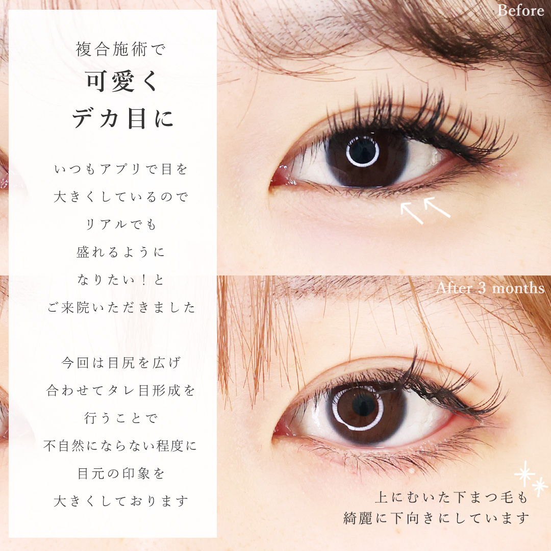 目尻切開術/グラマラスライン（タレ目形成）の症例写真 施術前後 