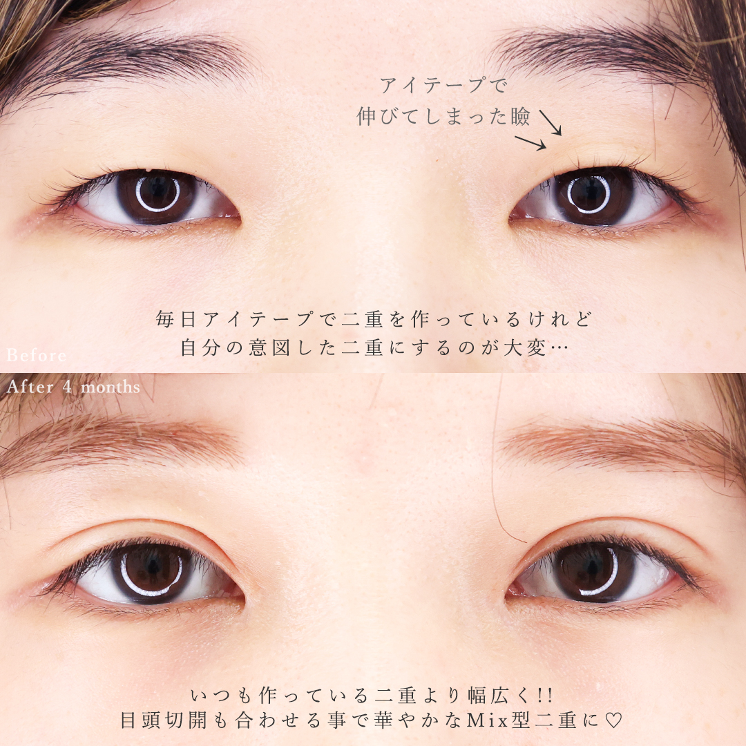 目頭切開術/二重埋没法の症例写真 施術前後 