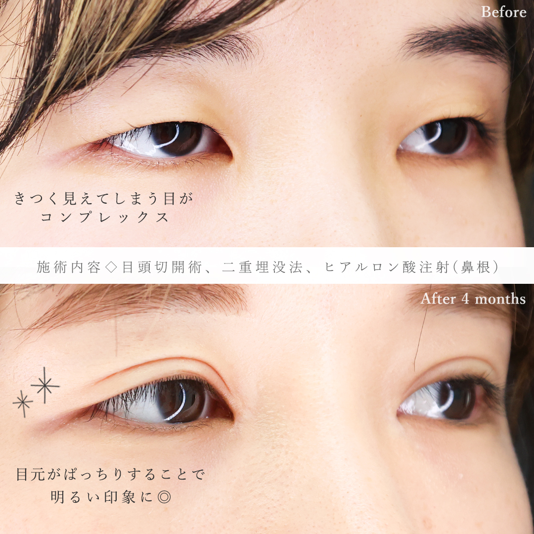 目頭切開術/二重埋没法の症例写真 施術前後 