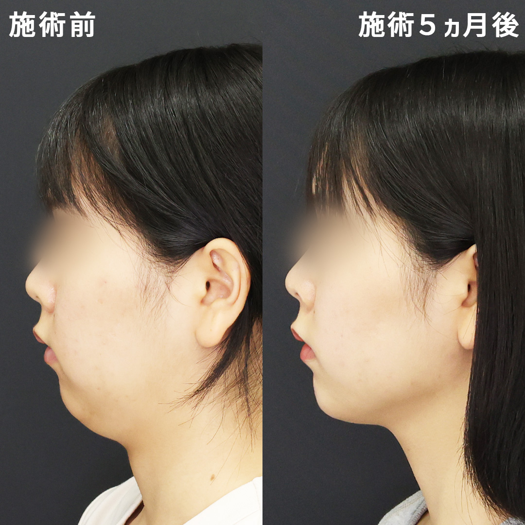 整えながら減らす小顔術│しぶとい二重顎を撃退