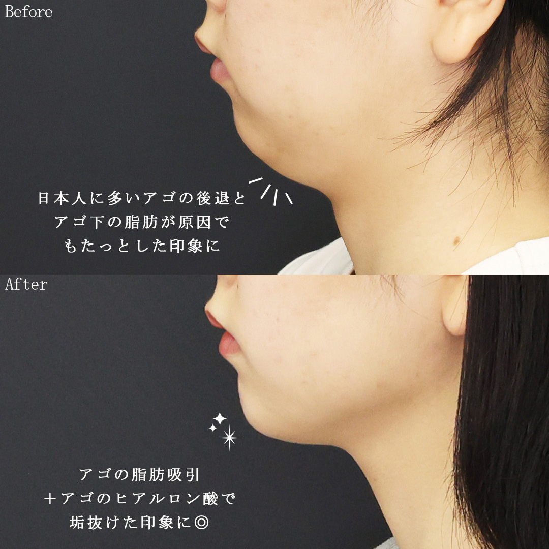 TAC式 ツヤ肌コラーゲンリフト®/顔の脂肪吸引/ジョールファット除去の症例写真 施術前後