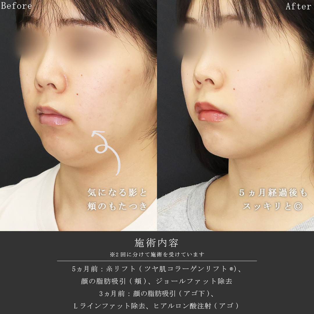 TAC式 ツヤ肌コラーゲンリフト®/顔の脂肪吸引/ジョールファット除去の症例写真 施術前後