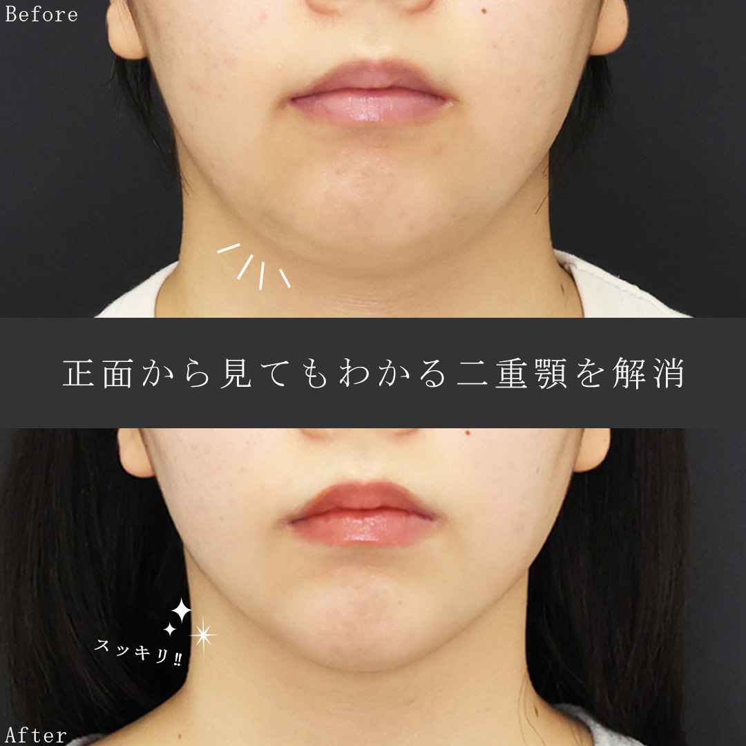 TAC式 ツヤ肌コラーゲンリフト®/顔の脂肪吸引/ジョールファット除去の症例写真 施術前後