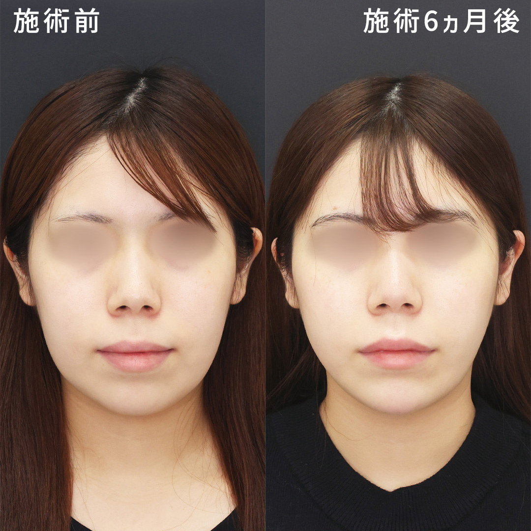 長期経過シリーズ｜脂肪吸引で叶える卵型フェイスライン