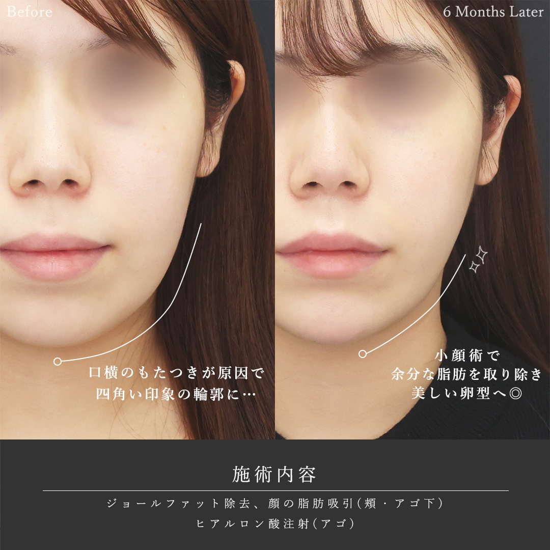 ジョールファット除去/顔の脂肪吸引/顎のヒアルロン酸注射の症例写真 施術前後 