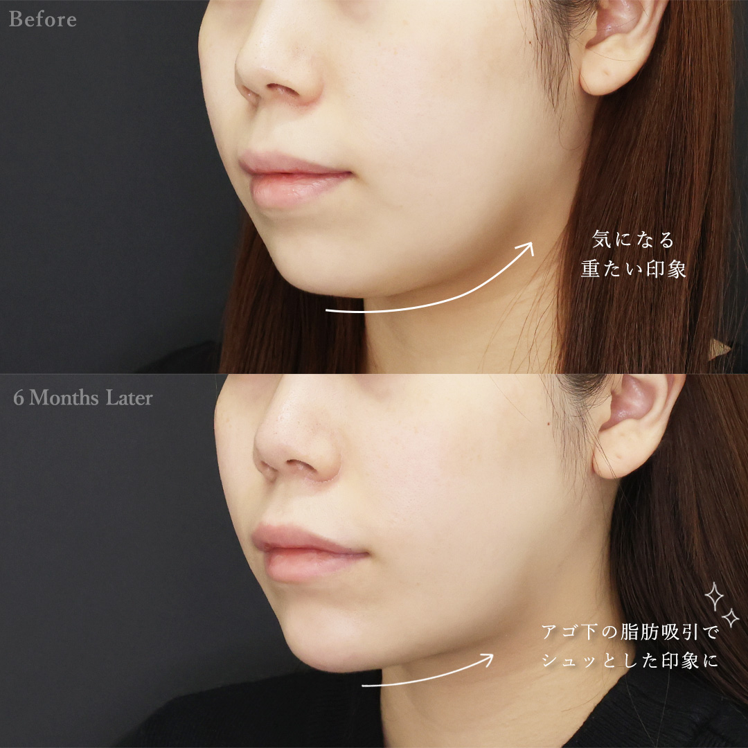 ジョールファット除去/顔の脂肪吸引/顎のヒアルロン酸注射の症例写真 施術前後 
