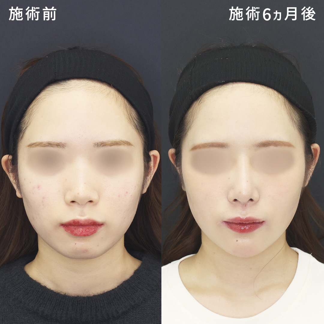 鼻の印象を薄く｜形成外科専門医の鼻整形