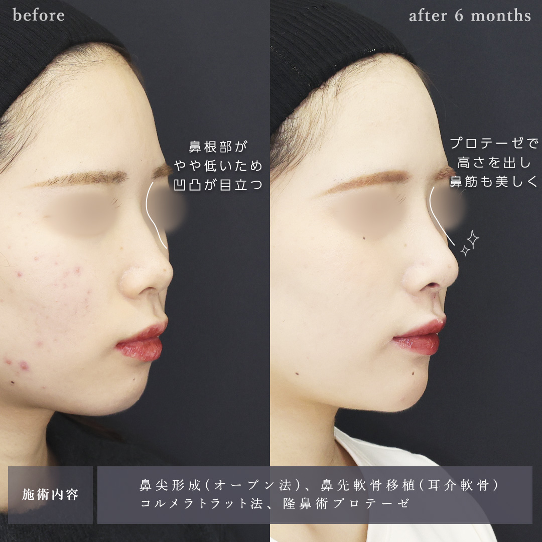 鼻尖形成・鼻尖縮小/鼻先軟骨移植/隆鼻術（プロテーゼ・自家組織）の症例写真 施術前後 