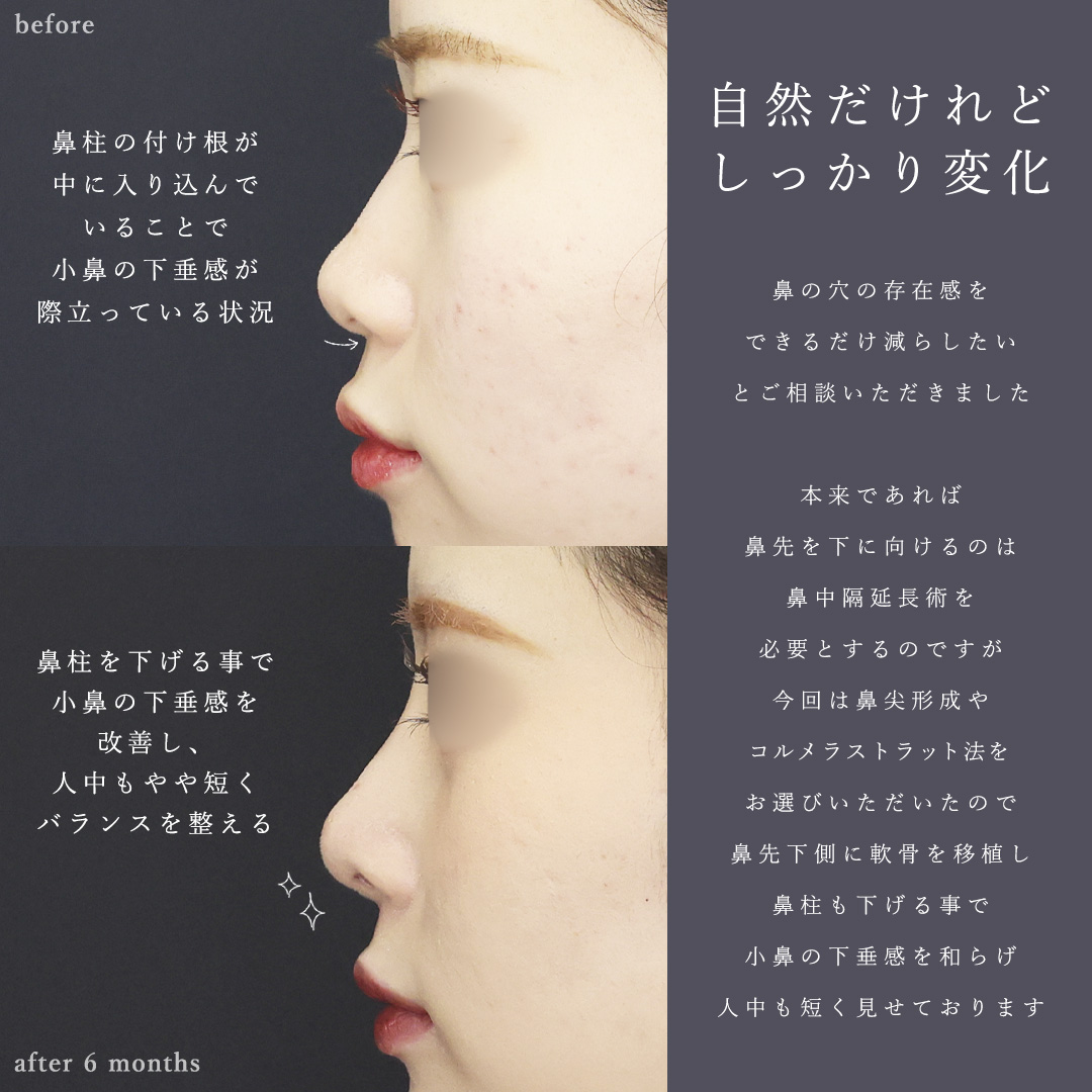 鼻尖形成・鼻尖縮小/鼻先軟骨移植/隆鼻術（プロテーゼ・自家組織）の症例写真 施術前後 