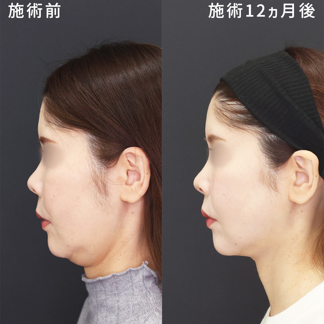 顔の美容外科手術 顔の美容外科手術 | 飯田秀夫 |本 | 通販 | Amazon