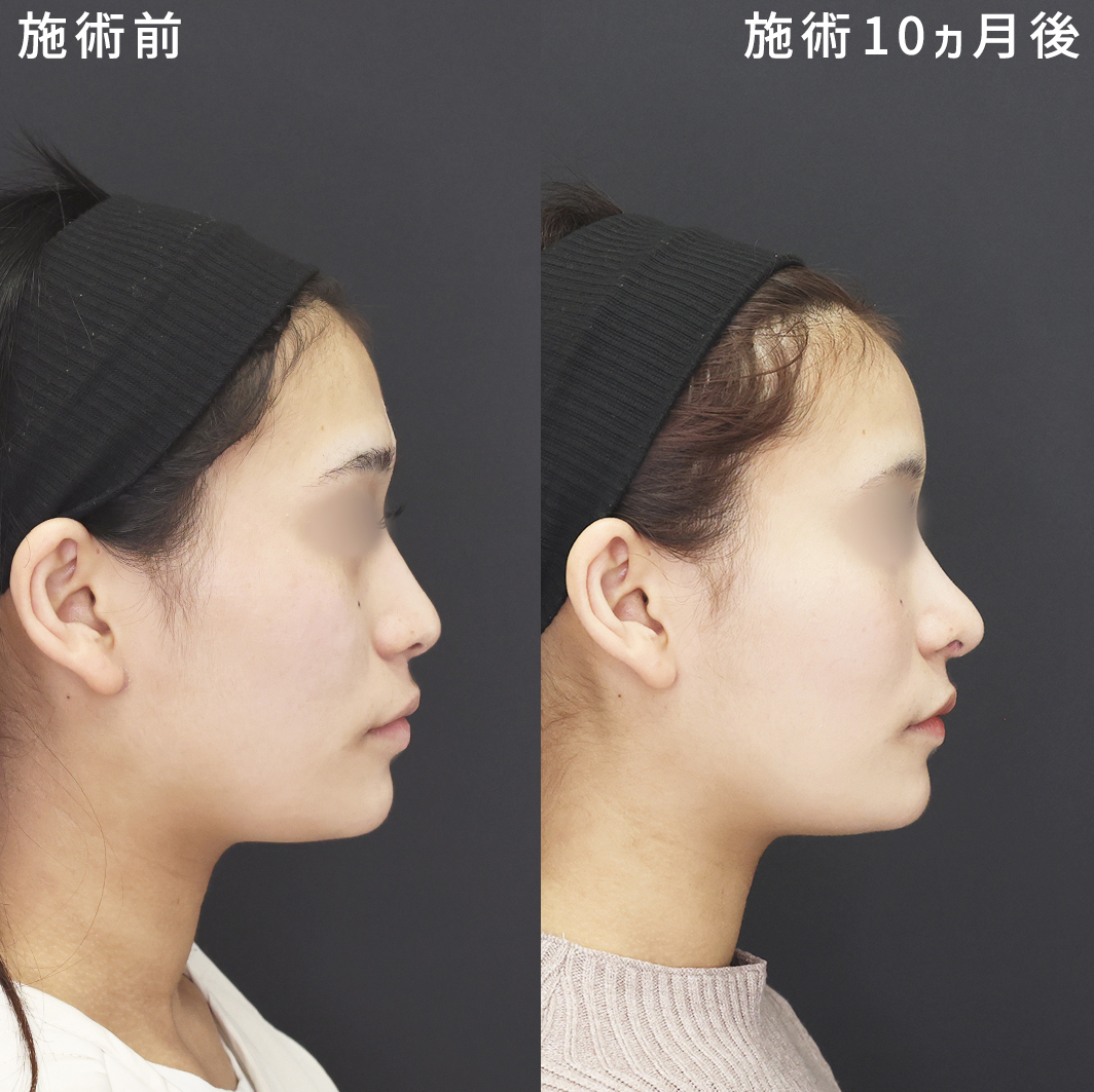 鼻整形×脂肪注入でS字ラインを美しく【長期経過症例】