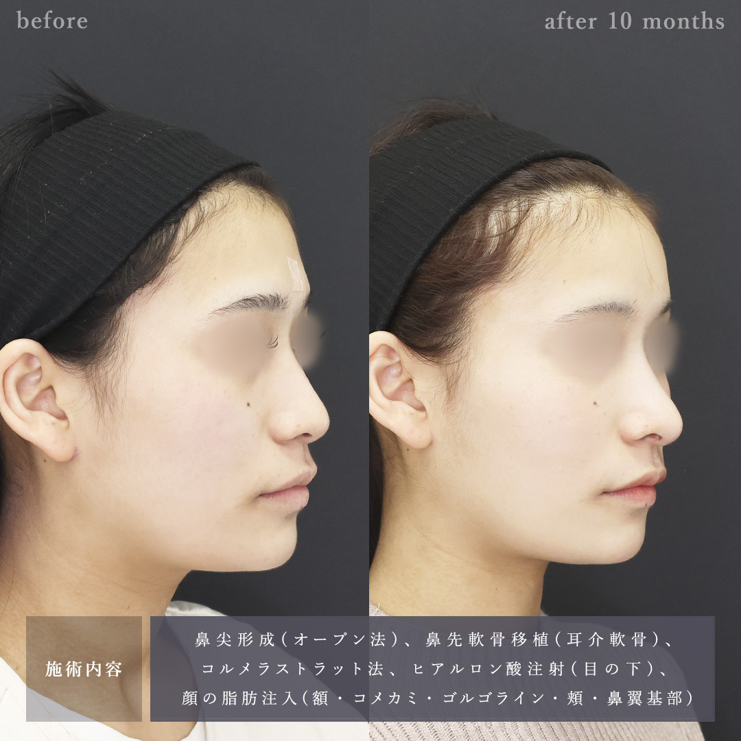 鼻尖形成・鼻尖縮小/鼻先軟骨移植/目の下のヒアルロン酸注射の症例写真 施術前後 