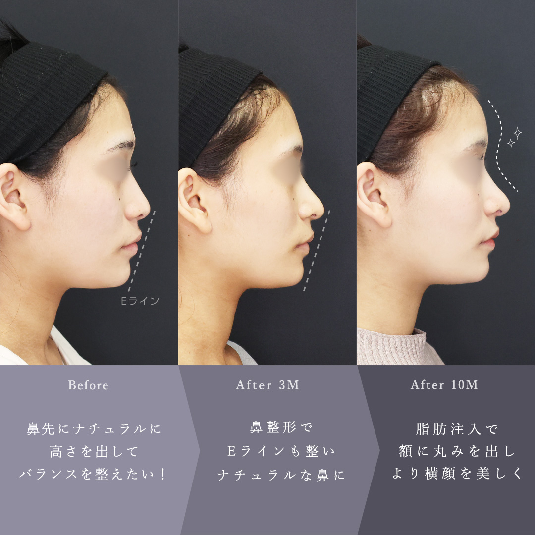 鼻尖形成・鼻尖縮小/鼻先軟骨移植/目の下のヒアルロン酸注射の症例写真 施術前後 