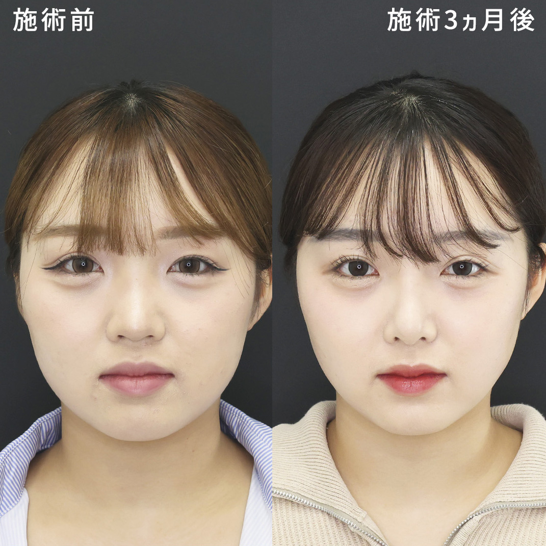 鼻尖形成・鼻尖縮小/鼻先軟骨移植/隆鼻術(プロテーゼ・自家組織)の症例写真 施術前後