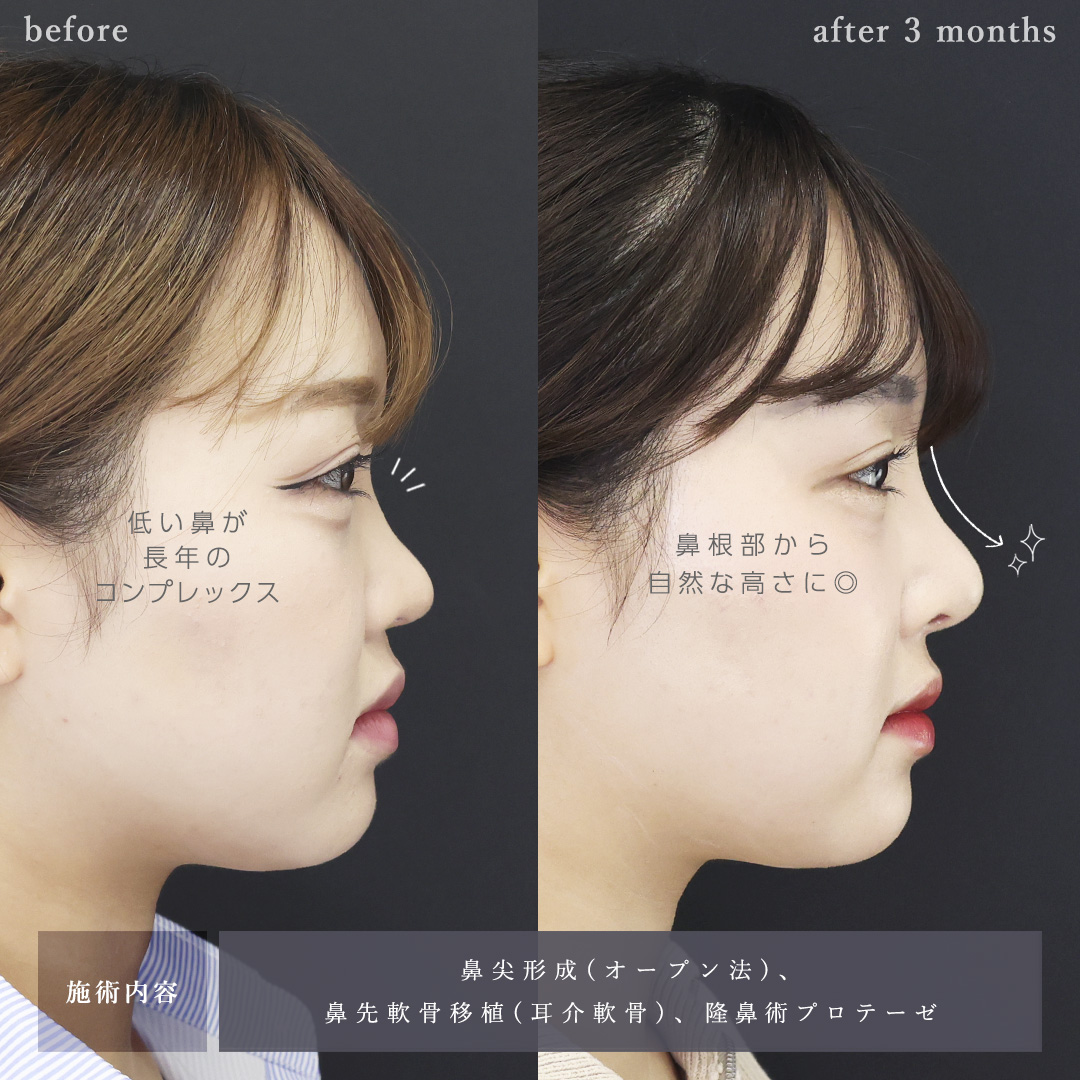 鼻尖形成・鼻尖縮小/鼻先軟骨移植/隆鼻術(プロテーゼ・自家組織)の症例写真 施術前後