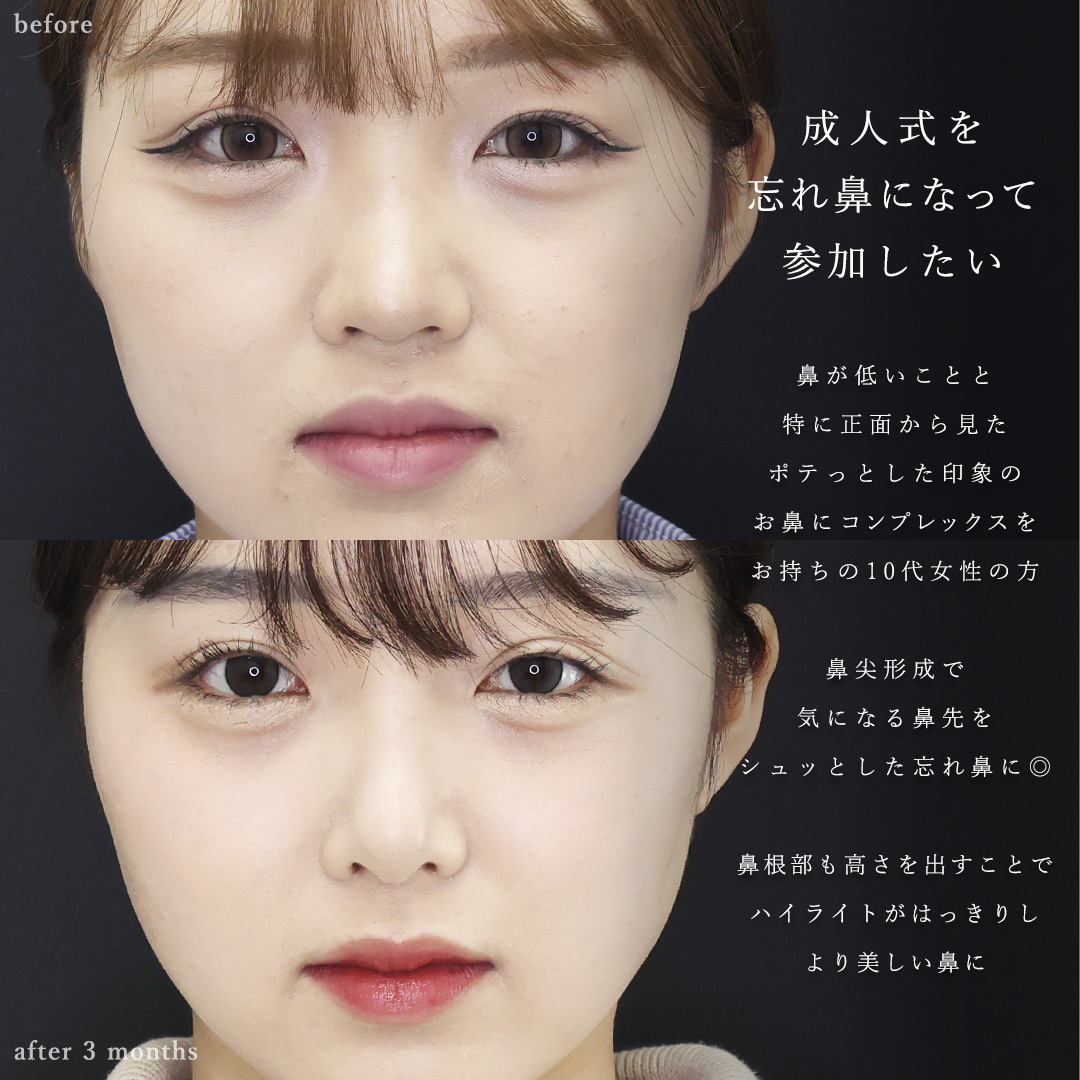 鼻尖形成・鼻尖縮小/鼻先軟骨移植/隆鼻術(プロテーゼ・自家組織)の症例写真 施術前後