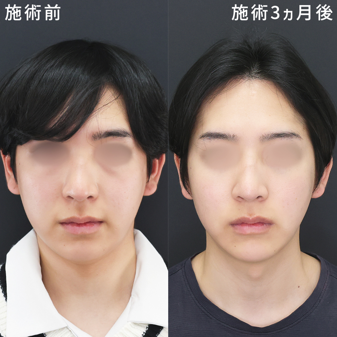 男性症例｜脂肪吸引×クマ取りでよりイケメンに