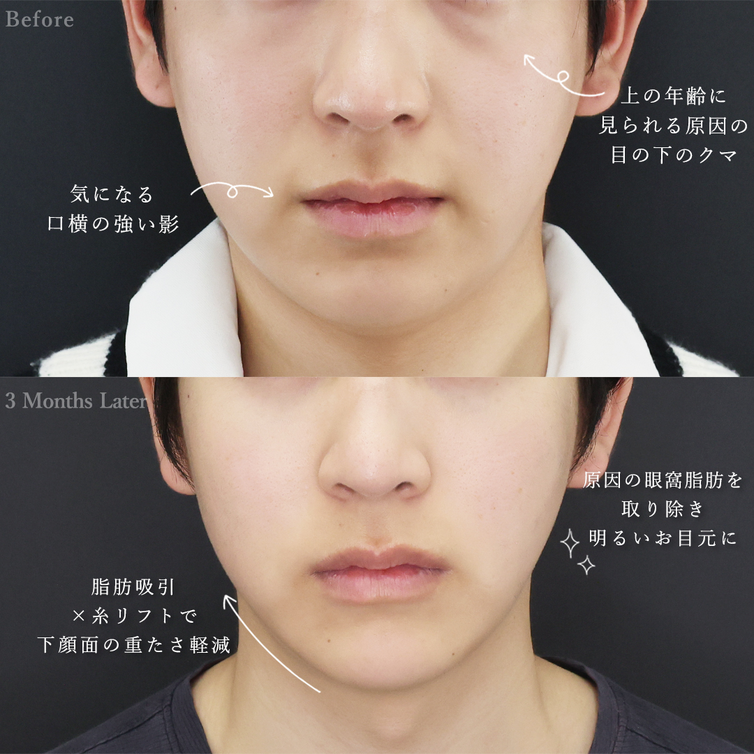 下眼瞼脱脂術（目の下のたるみ取り・目の下の脂肪ふくらみ取り）/ジョールファット除去/顎下の脂肪吸引の症例写真 施術前後 