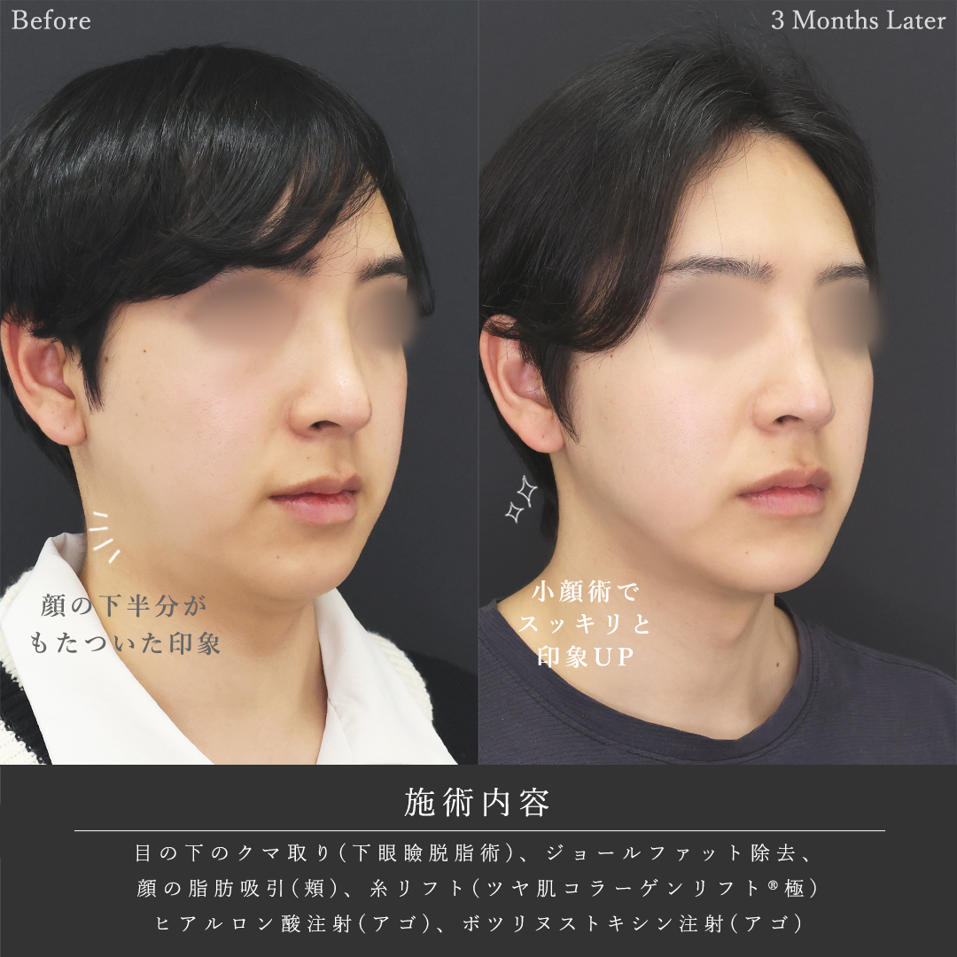 下眼瞼脱脂術（目の下のたるみ取り・目の下の脂肪ふくらみ取り）/ジョールファット除去/顎下の脂肪吸引の症例写真 施術前後 