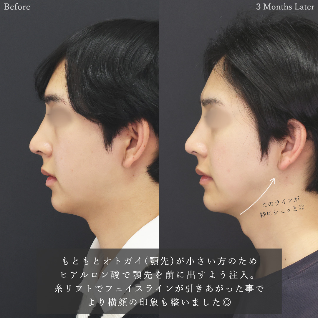 下眼瞼脱脂術（目の下のたるみ取り・目の下の脂肪ふくらみ取り）/ジョールファット除去/顎下の脂肪吸引の症例写真 施術前後 