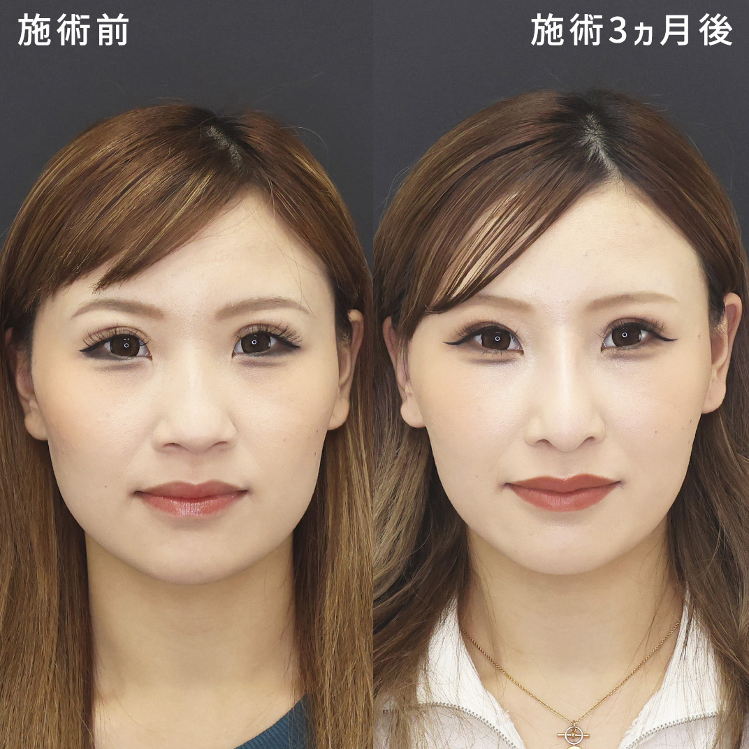 【鼻中隔延長術】あぐら鼻を解消