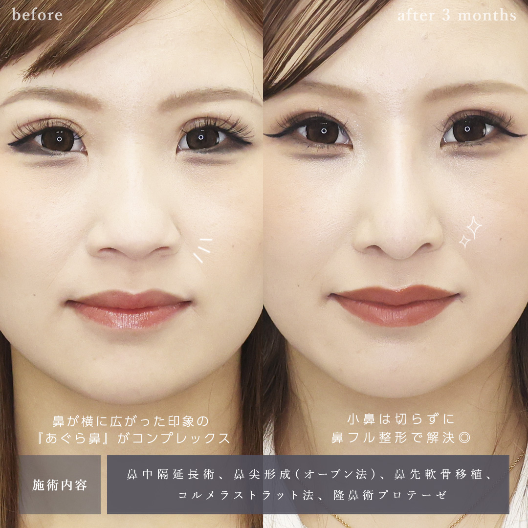 鼻中隔延長術/鼻尖形成・鼻尖縮小/鼻先軟骨移植の症例写真 施術前後 