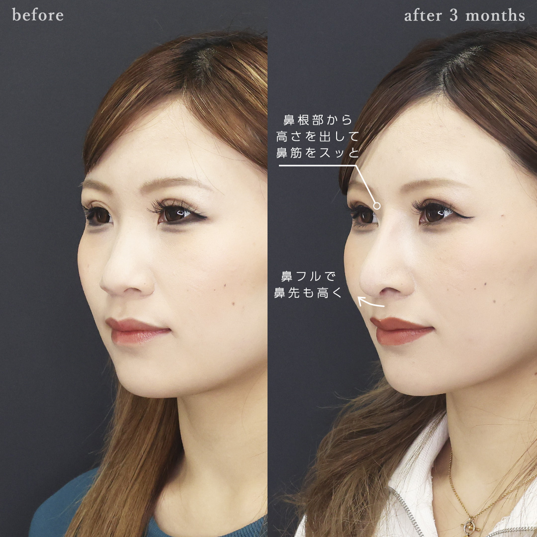 鼻中隔延長術/鼻尖形成・鼻尖縮小/鼻先軟骨移植の症例写真 施術前後 