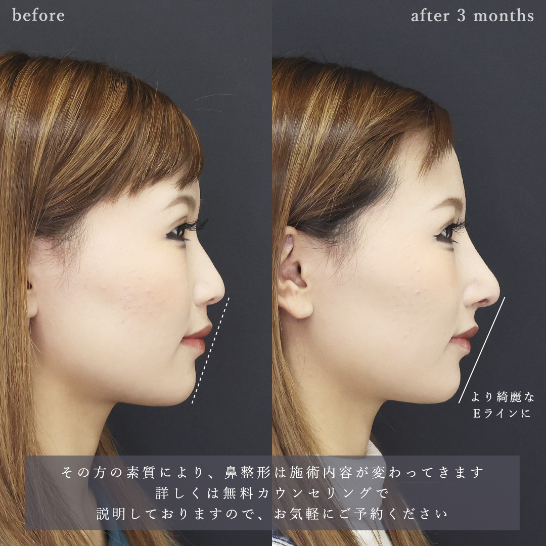 鼻中隔延長術/鼻尖形成・鼻尖縮小/鼻先軟骨移植の症例写真 施術前後 