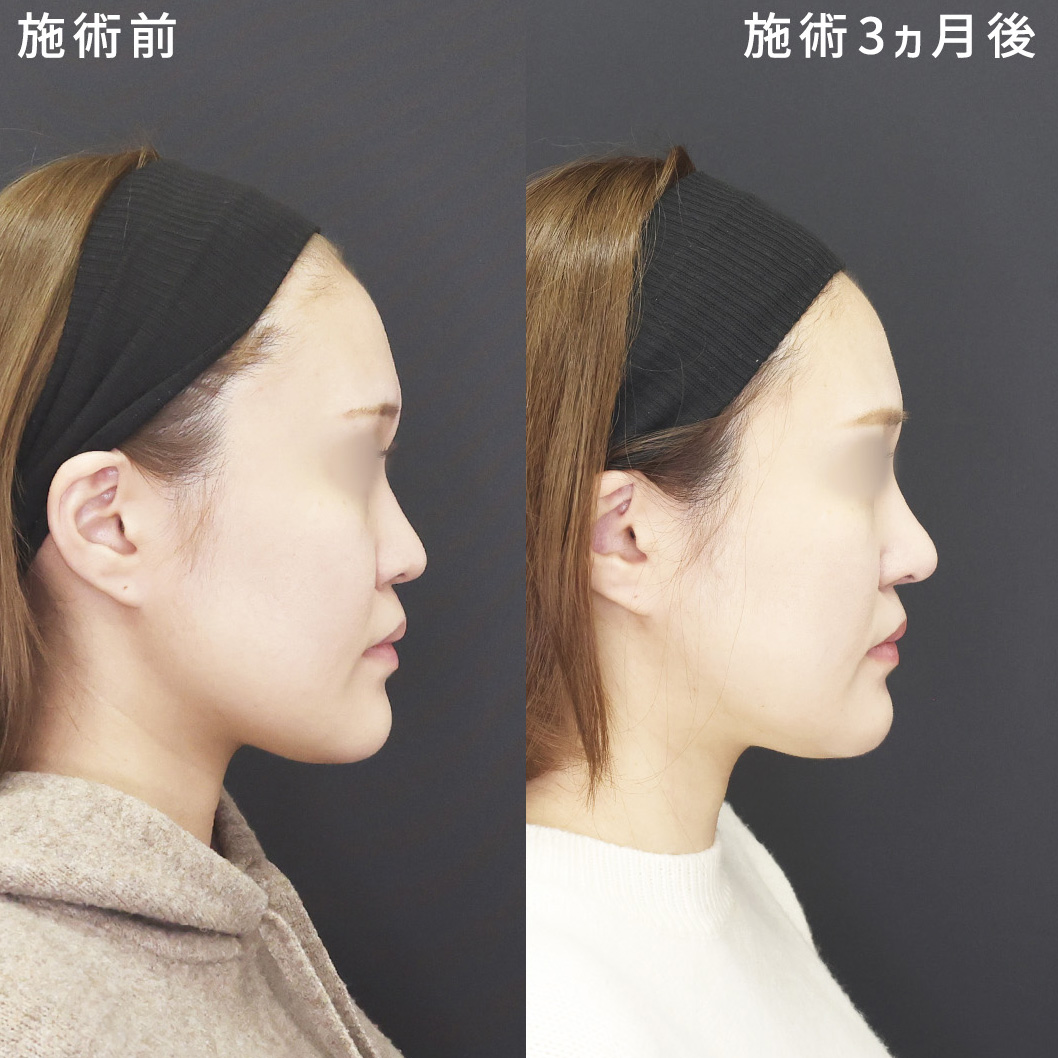 自然な鼻フル整形【鼻中隔延長術×小顔術】