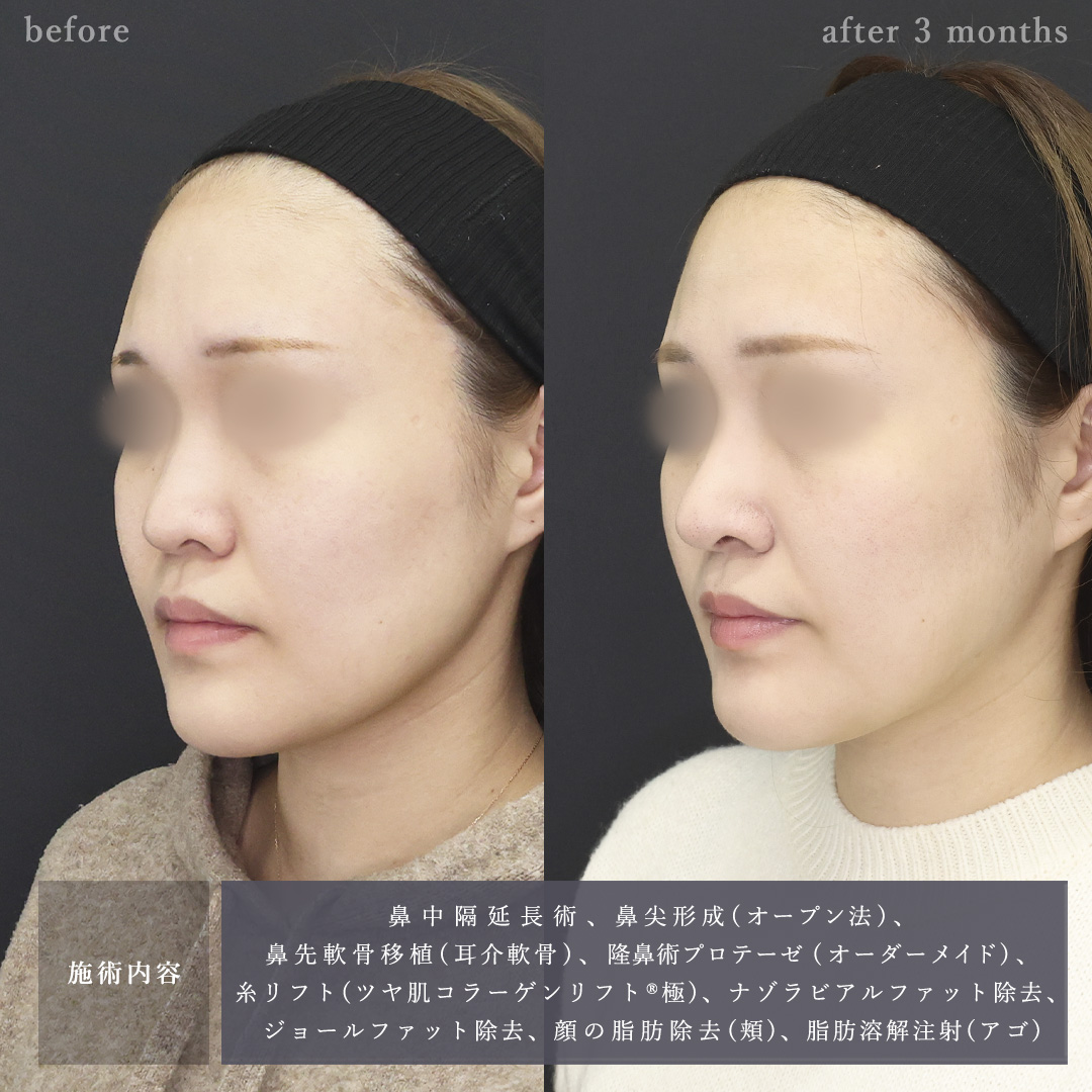 ナゾラビアルファット除去/鼻中隔延長術/鼻尖形成・鼻尖縮小の症例写真 施術前後 