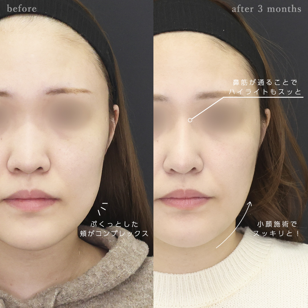 ナゾラビアルファット除去/鼻中隔延長術/鼻尖形成・鼻尖縮小の症例写真 施術前後 
