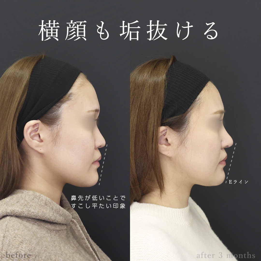 ナゾラビアルファット除去/鼻中隔延長術/鼻尖形成・鼻尖縮小の症例写真 施術前後 