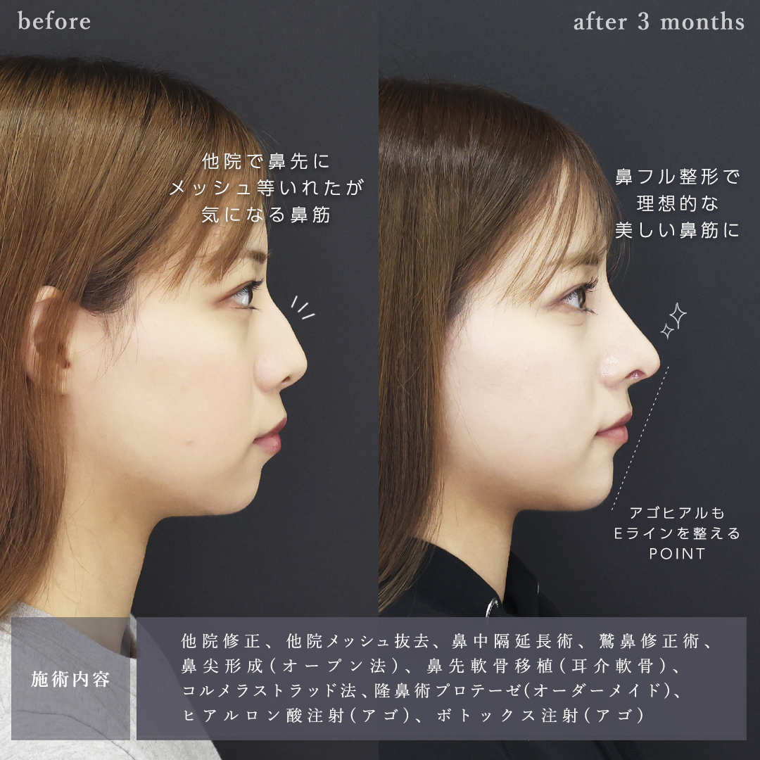 鼻中隔延長術/鼻尖形成・鼻尖縮小/鼻先軟骨移植の症例写真 施術前後 