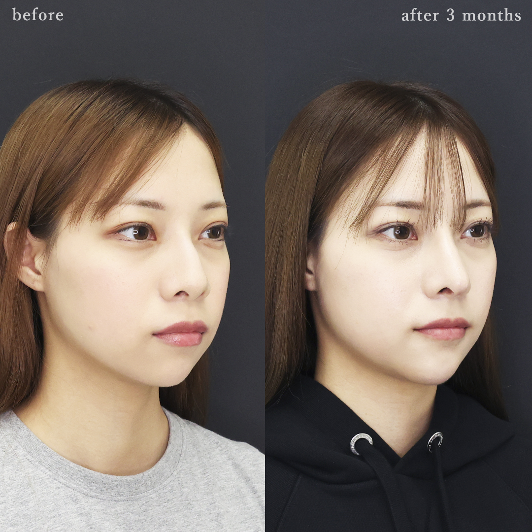 鼻中隔延長術/鼻尖形成・鼻尖縮小/鼻先軟骨移植の症例写真 施術前後 