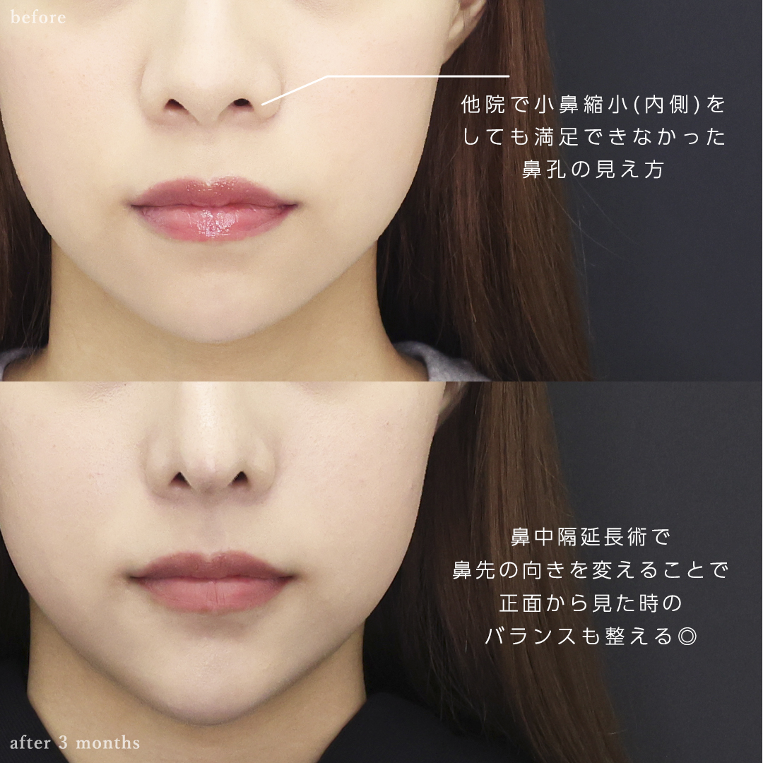 鼻中隔延長術/鼻尖形成・鼻尖縮小/鼻先軟骨移植の症例写真 施術前後 