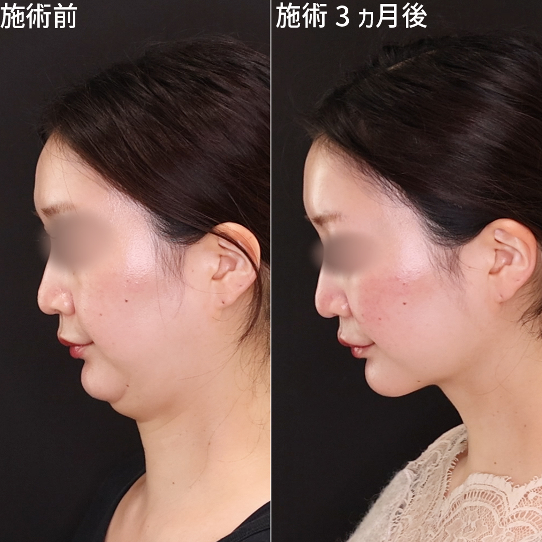 Dr.森執刀、満足度の高い小顔整形｜二重顎で美しいフェイスラインに
