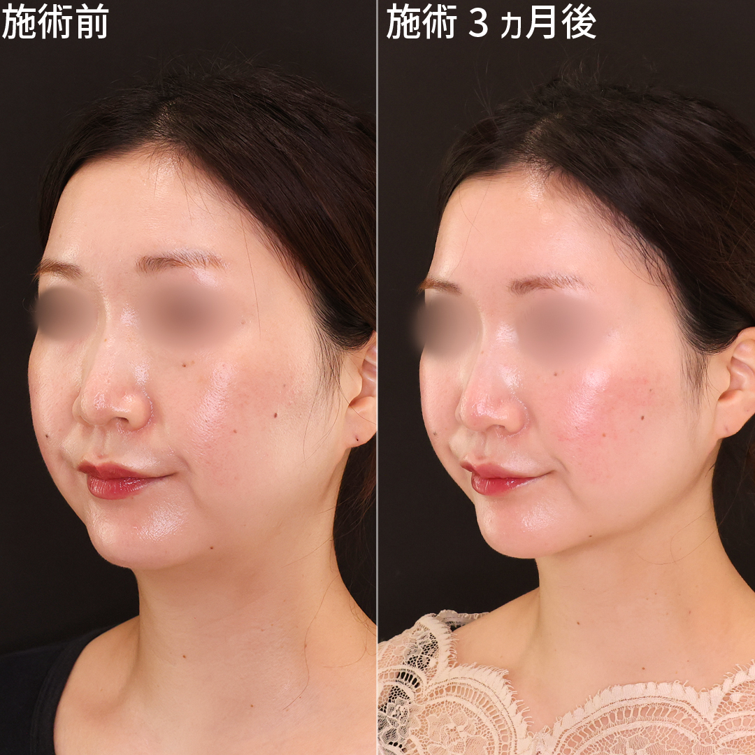 小顔整形｜パーフェクトフェイスライン/顔の脂肪吸引/Lラインファット除去（エラ下脂肪除去）の症例写真 施術前後 