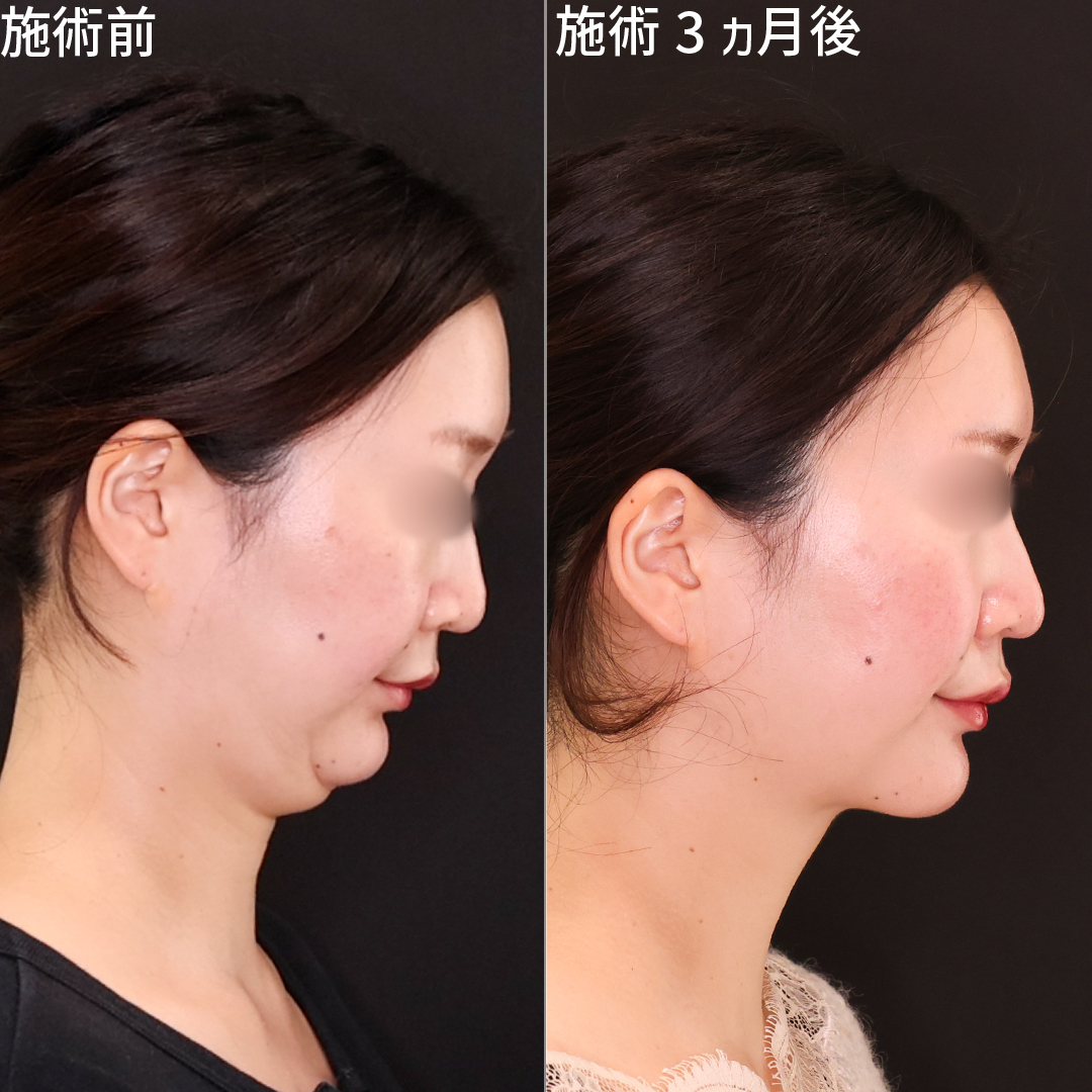 小顔整形｜パーフェクトフェイスライン/顔の脂肪吸引/Lラインファット除去（エラ下脂肪除去）の症例写真 施術前後 