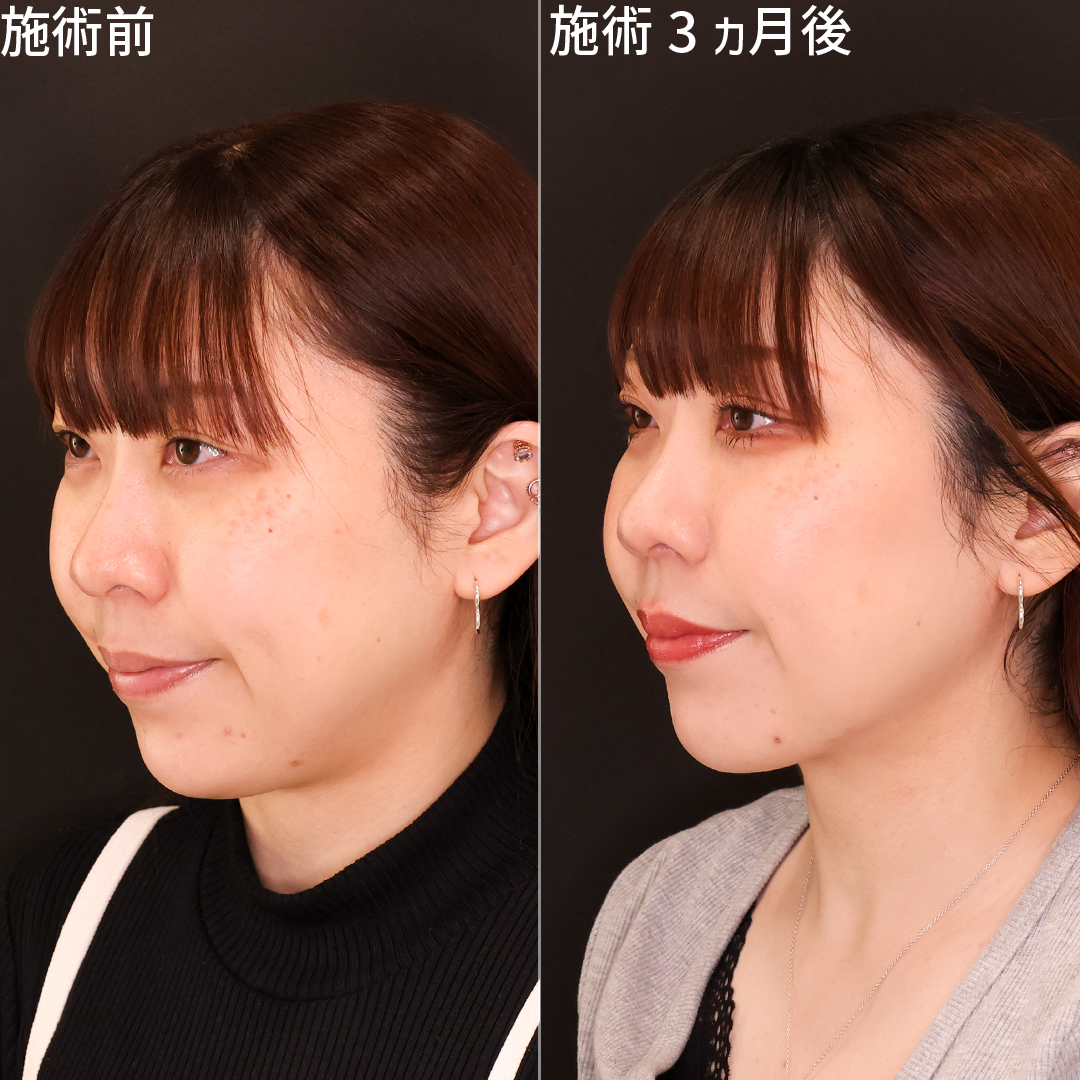 【Lラインファット除去】顔と首の境界線クッキリ|Dr.森の小顔整形【顎下脂肪吸引】