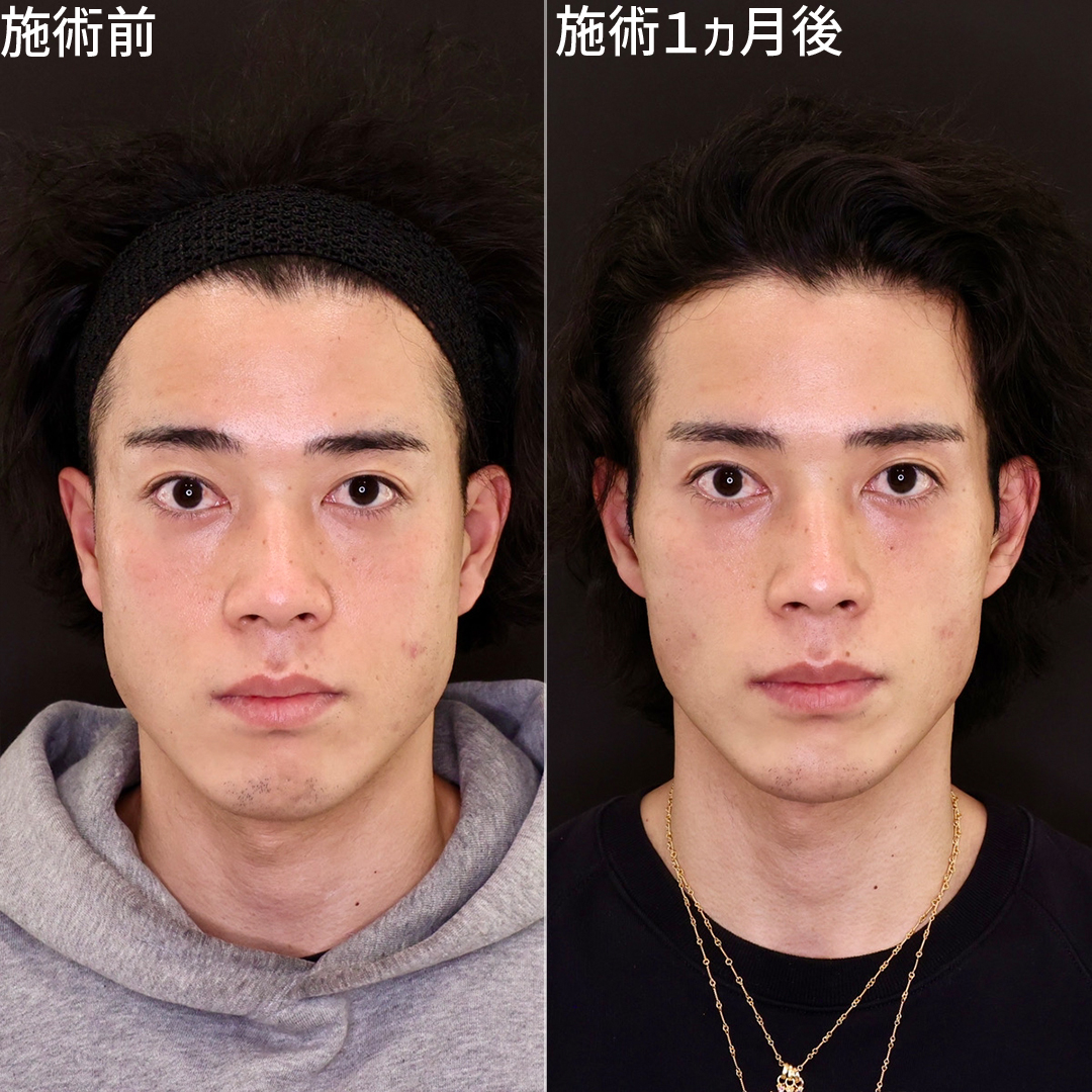 ジョールファット除去/TAC式 ツヤ肌コラーゲンリフト®/顔の脂肪吸引の症例写真 施術前後 