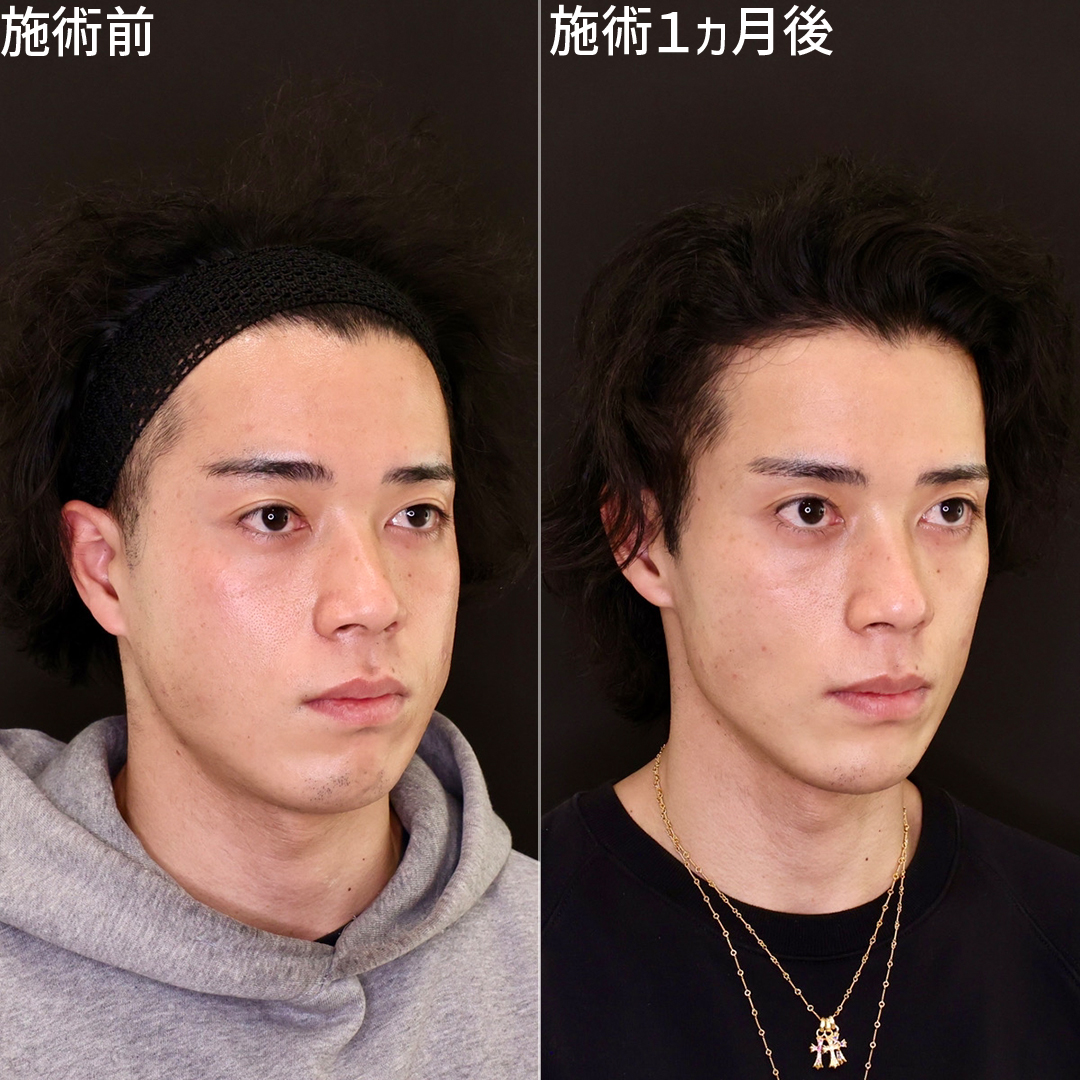 ジョールファット除去/TAC式 ツヤ肌コラーゲンリフト®/顔の脂肪吸引の症例写真 施術前後 