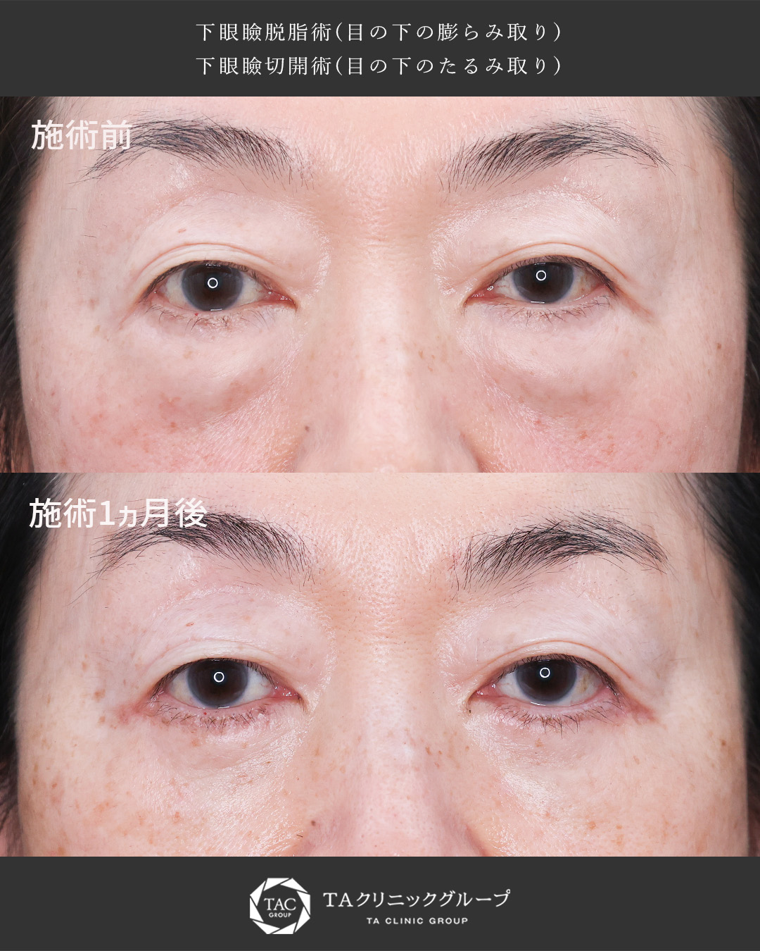 目の下の膨らみ取りでお目元を更に若々しく