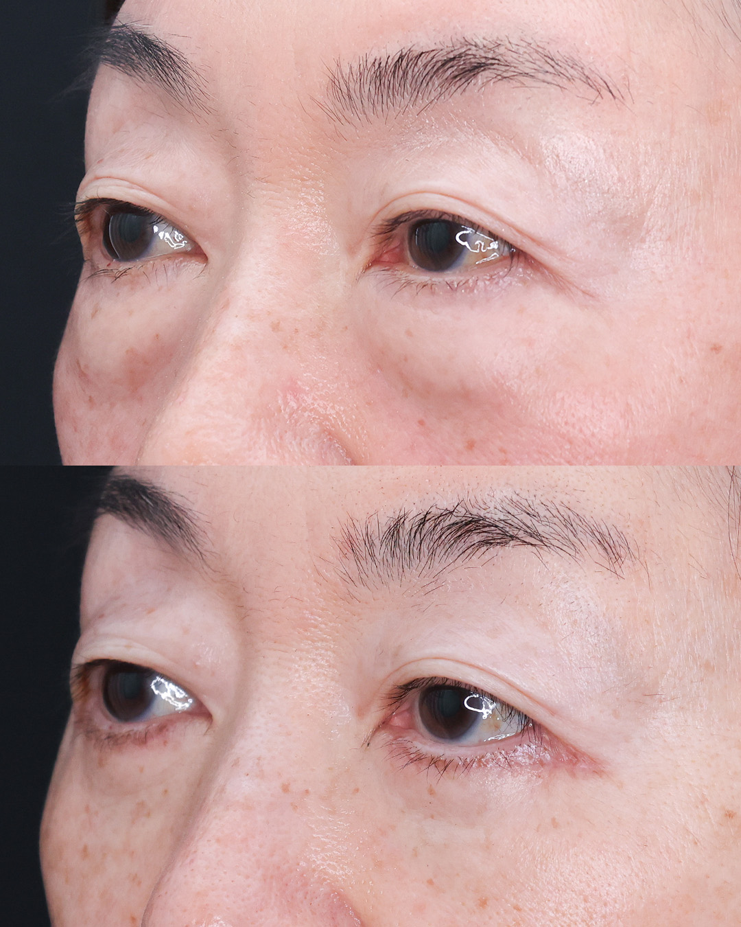 下眼瞼切開術（クマ・たるみとり）/下眼瞼脱脂術（目の下のたるみ取り・目の下の脂肪ふくらみ取り）の症例写真 施術前後 