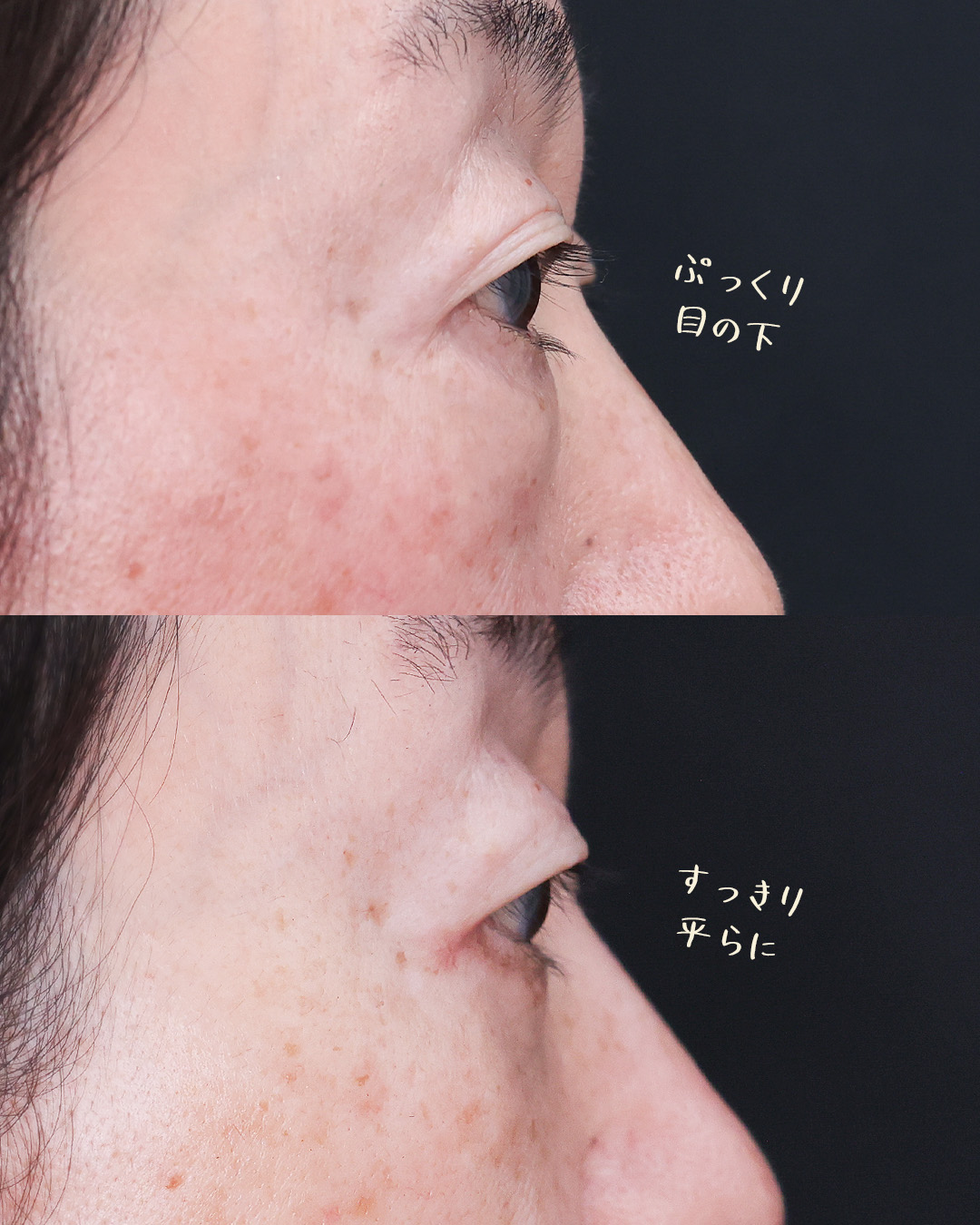 下眼瞼切開術（クマ・たるみとり）/下眼瞼脱脂術（目の下のたるみ取り・目の下の脂肪ふくらみ取り）の症例写真 施術前後 