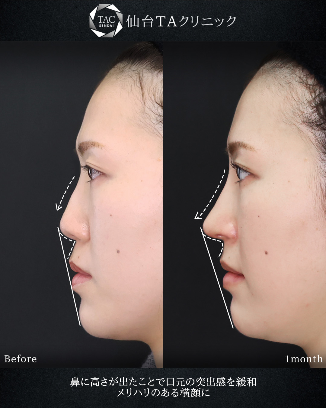 鼻中隔延長術/鼻尖形成・鼻尖縮小/鼻先軟骨移植の症例写真 施術前後 