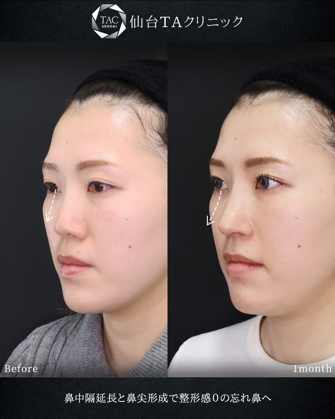 鼻中隔延長術/鼻尖形成・鼻尖縮小/鼻先軟骨移植の症例写真 施術前後 