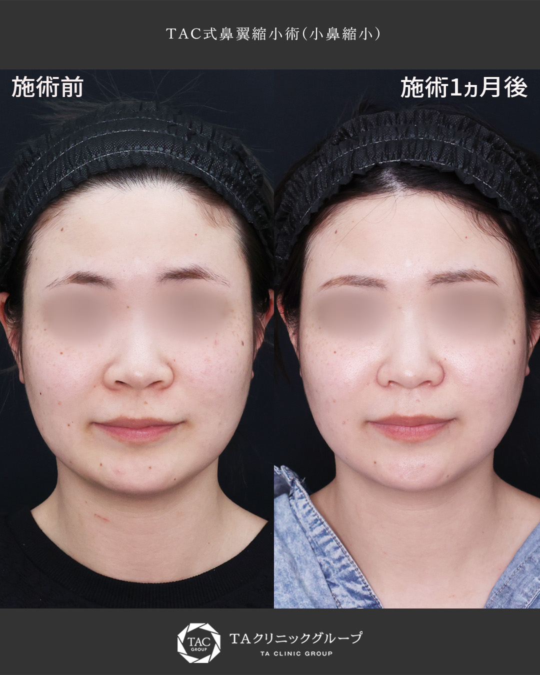 広がった小鼻をすっきり◎あぐら鼻改善